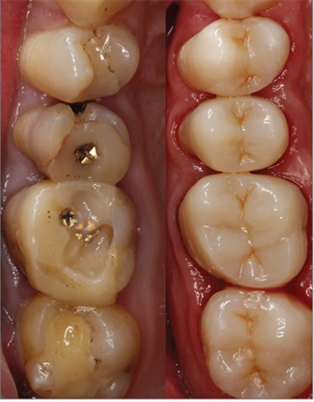 Continuing Education: Indirect Posterior  Composite Restorations Dr. Samir Karimov explores indirect posterior composite restorations and the development of new curing techniques to make this process easier.