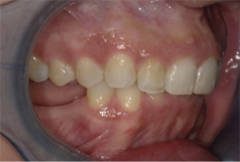 Short-Term Ortho: Now Even Shorter Dr. Noel Ananthan discusses how combining short-term orthodontics with manual osteoperforation treatments (MOPs) has led to more rapid movement of teeth—and shorter treatment times for patients.
