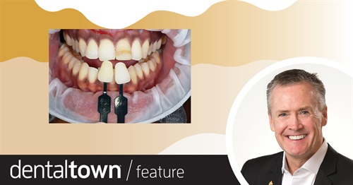 Mastering Shade Selection in a Limited Area of the Smile Zone  Dr. Scott Finlay discusses how to successfully communicate with the lab to optimize function and aesthetics with modern materials (with a focus on micro-aesthetics).