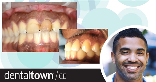 Continuing Education: Front-Line Work Dr. LeRoy Horton, a board-certified implantologist with two practices in the greater Seattle area, takes readers through a step-by-step process of performing an immediate implant placement in the anterior maxilla, with discussion of specific principles that will aid in surgical, restorative and aesthetic success.