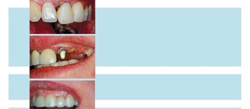 Erupting Compromised Teeth for Restoration Dr. Joe Whitehouse, a proponent of minimally invasive dental procedures, explains when it makes sense to erupt compromised teeth that have very little clinical crown showing, which allows them to be treated with restorative work rather than being replaced with an implant.
