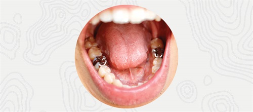 Hi-Ho, Silver! Silver diamine fluoride is mostly used to treat children, but Drs. Justin J. Cardarelli and Marmar Mesgarzadeh believe the caries preventer and treatment makes sense for certain cases of adult patients, too. Their article discusses three such situations and explains how the treatment can be tiered according to the patient’s clinical presentation and follow-up reliability.