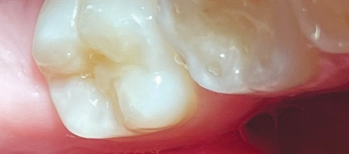 The Future Is Now Dentaltown editorial board member Dr. Jeanette MacLean takes a deep dive on a new product designed to help regenerate tooth enamel and remineralize teeth—a new, aesthetics-friendly bridge in the gap between “watch and wait” monitoring and conventional restorations.
