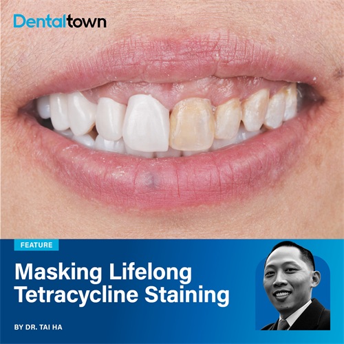 Masking Lifelong Tetracycline Staining Dr. Tai Ha demonstrates a no-prep, digital approach using ultra-thin, 3D-printed zirconia veneers to restore aesthetics conservatively.