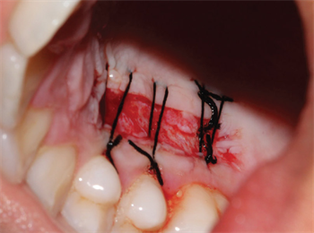 Augmentation of Keratinized Gingiva In this case presentation Dr. Manthan Desai shares the advantages of augmenting attached gingiva.