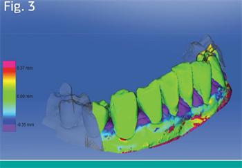 Intraoral Scanning: A Great Resource in Today’s Dentistry Dr. Moritz Zimmermann explores digital dentistry and the advantages intraoral scanning provides.