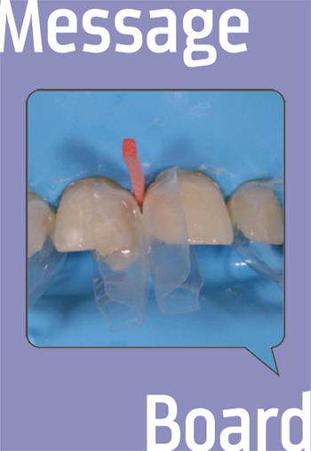 Diastema Closure—Bioclear/Polychromatic Approach A Townie favorite closes a gap and shares his tricks.