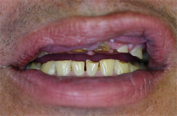 Functional Osseous Crown Lengthening: A Primer Denver periodontist and Dentaltown board member Dr. Brian Gurinsky discusses functional crown lengthening, including a primer on when and why the procedure makes sense for patients.
