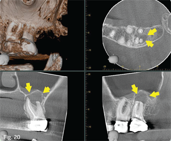 Continuing Education: Is Endodontics Dying? Dr. Manor Haas’ latest endodontics course for Dentaltown discusses whether the specialty of endodontics will be affected by the rise of implant dentistry, and why endo will continue to play a significant role in dentistry. 