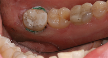 Indirect vs. Direct Restorations Dr. Richard Rosenblatt discusses indications for selecting the right milling material for indirect and direct resin restorations.