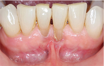 Show Your Work: Mandibular Frenectomies Made Simple Dr. Timothy Anderson shares a case in which he treated a mandibular frenectomy with a CO2 laser, which requires no anesthesia and no sutures, and involves almost no blood loss.