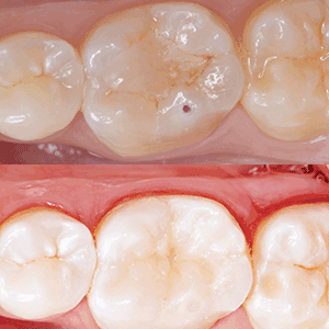 To Fill or Restore? Drs. Italo Moraes and Bruno Carlini discuss patient education.