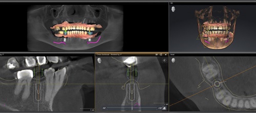 Digitally Guided Implant Placement Dr. Dee Dee Meevasin explains how her practice uses a 3D printer to create surgical guides for implant cases. The result? Cases completed in fewer appointments, with lower failure rates, and eliminated lab delays or production issues. Meevasin also shares a case study to illustrate these principles in action. 