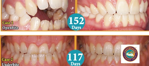 Product Profile: Fastbraces Finally, a technology that helps dentists move teeth really fast, safely