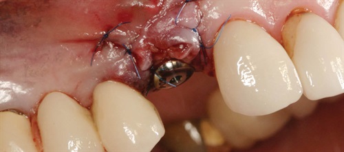 Immediate Results Dr. Emil M. Verban Jr. discusses the factors behind successful immediate implant placement, particularly when it comes to implants being placed in the anterior maxilla. Verban’s recap of the state of the implant industry includes more than 60 images of successful implants, aesthetic failures, proper techniques and more. 