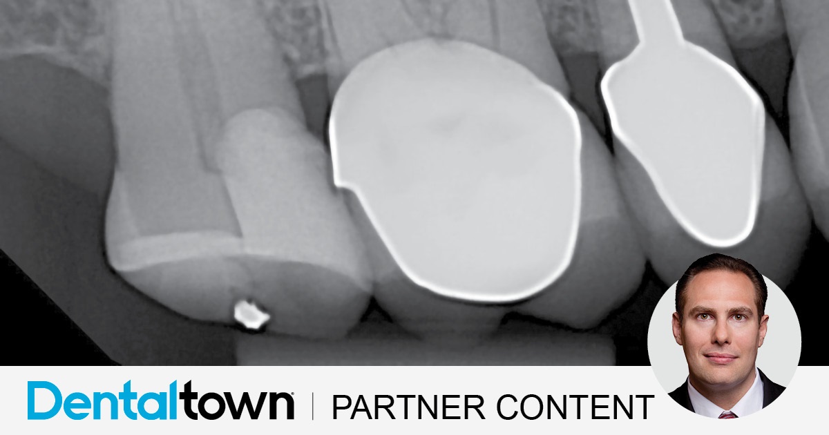 Clinical Case Spotlight: Using the Isolite Pro for a Difficult Posterior Restoration