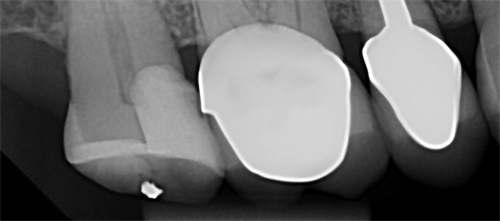 Clinical Case Spotlight: Using the Isolite Pro for a Difficult Posterior Restoration Dr. Arthur R. Volker demonstrates the restoration of a large multisurface direct composite restoration which was facilitated using an isolation system.