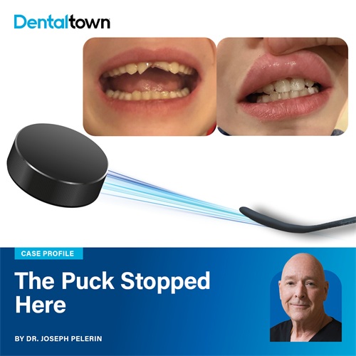 The Puck Stopped Here A traumatic pediatric dental injury becomes a lesson in conservative pulp preservation, showing how biologically respectful treatment can protect vitality after severe trauma.