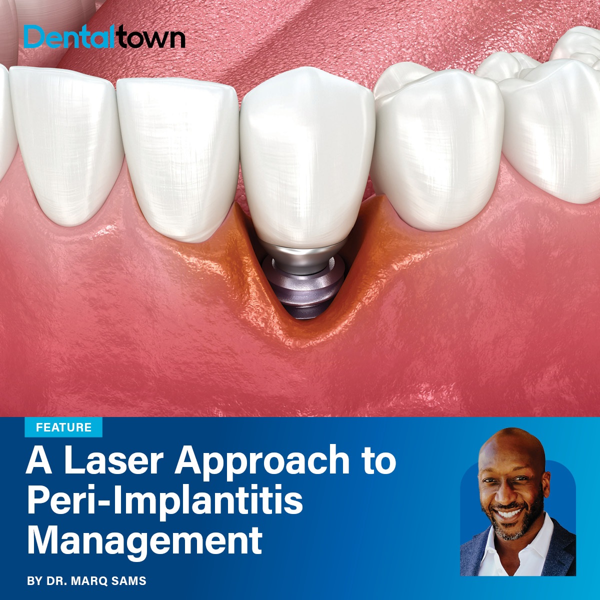 A Laser Approach to Peri-Implantitis Management