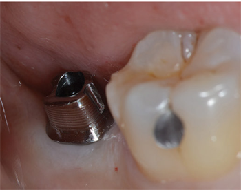 Implant Maintenance Protocol Drs. Thanos Ntounis and Lillie Pitman explore the importance of implant maintenance and how to prevent complications.