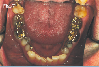 Function and Esthetics  of Lithium Disilicate  Restorations Dr. Brent Engelberg explores combining orthodontics with restorative treatment.