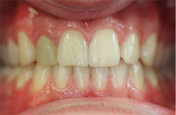 Keep it Simple Stupid Dr Zaki Kanaan argues the case that when it comes to implants, treatment should be kept as simple as possible.