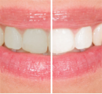 Time Out Discover seven Easy steps to create more opportunities to provide more Teeth Whitening Treatments and increase your turnover and profits.