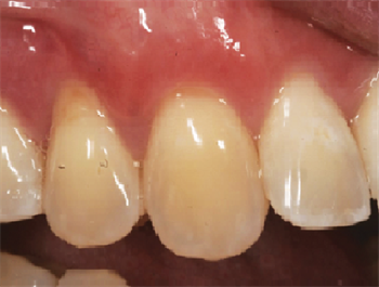Does My Patient Need a Gum Graft? Dentaltown board member Dr. Brian Gurinsky discusses the classification system for tissue grafts, and how to understand how to determine if a patient needs one.