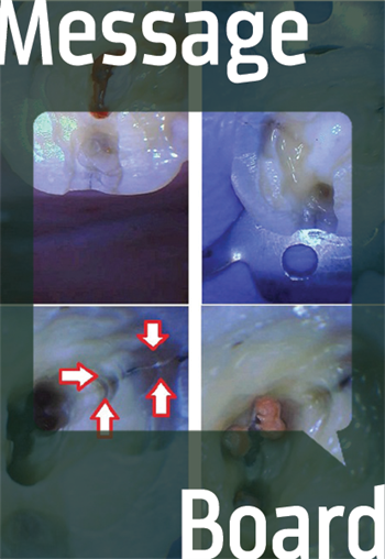 Fool Me Once... A Townie treatment-plans root canal treatment with most of his cracked-tooth cases.