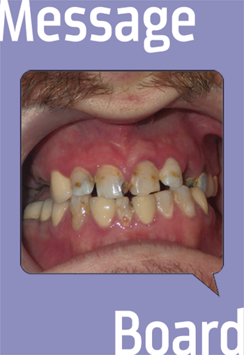Large Implant Case—Let’s Treatment Plan It Together A Townie enlists suggestions for a significant case.