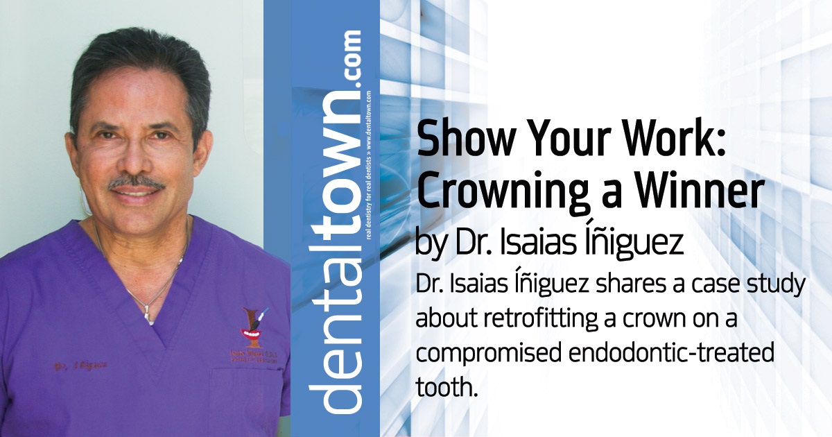 Crowning a Winner Dr. Isaias Íñiguez shares a case study about retrofitting a crown on a compromised endodontic-treated tooth.