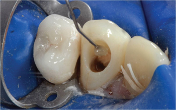Crowning a Winner Dr. Isaias Íñiguez shares a case study about retrofitting a crown on a compromised endodontic-treated tooth.
