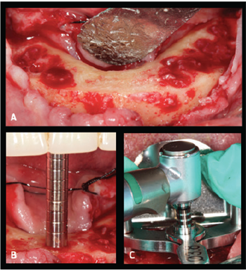 Fixed-Implant Rehabilitation Drs. Andonis Terezides and Sundeep Rawal share their concept for fixed mandibular full-arch rehabilitation.