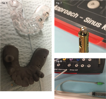 Show Your Work: A Simple Approach to Crestal Sinus Augmentation  Dr. Matthew F. Bickel walks readers through a recent two-implant sinus lift.