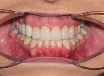 Orthodontic Restorative Interface Dr. Barry Buckley shares an Invisalign case.