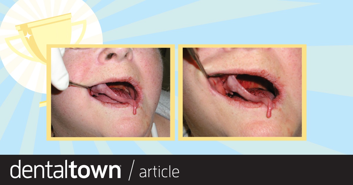 'My Worst Mouth' Contest Results On Dentaltown’s message boards, we asked Townies to submit photos of the most challenging mouths they’ve ever treated. From all the posts, we
selected eight cases to vie for top honors in the “My Worst Mouth” Contest in our January issue. See which case Townies said was the worst of the worst!