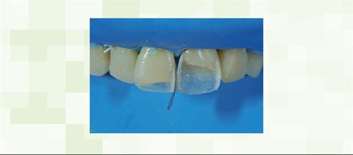 Face Forward One of our most-followed Townies, Dr. Arthur R. Volker, and two colleagues explain matrixing strategies for anterior and facial surfaces, discuss the indications and pros and cons of each option, and share case studies that illustrate the principles involved.
