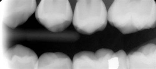 Second Opinion: The Tooth the Dentist Rejected Dr. Jarod Johnson discusses when early extraction of permanent first molars can be appropriate for pediatric patients and shares a case study illustrating the principles behind the decision.