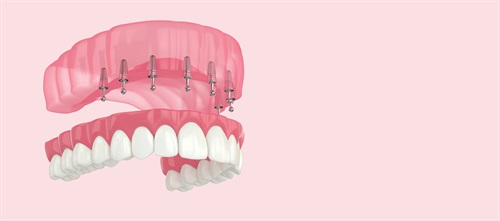 A Partially Analog Approach Dr. Emil M. Verban Jr. explains which key factors must be evaluated when determining which prosthetic design should be used for optimal success in implant dentistry, and shares a case study involving guided placement of implants to support an all-on-X maxillary prothesis.