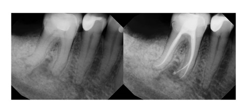 Clinical Case Spotlight: Efficient and Predictable Endodontics Dr. Biraj Patel showcases an endodontic case that provided a streamlined, predictable and efficient treatment by utilizing EdgeFile X7 rotary files and EdgeBioCeramic Sealer.