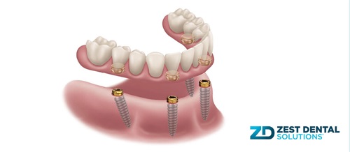 Product Profile: Locator Angled Abutment More flexibility, more patients, same trusted system