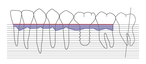 4 Things to Know About Peri-Implantitis Dr. Giacomo Tarquini summarizes peri-implant diseases in four key points and presents a clinical case demonstrating a novel surgical protocol using an ultrasonic device for peri-implantitis.