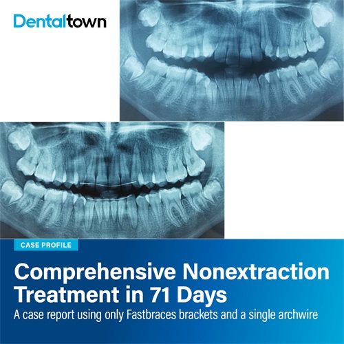 Case Profile: Fastbraces A case report using only Fastbraces brackets and a single archwire in 71 Days
