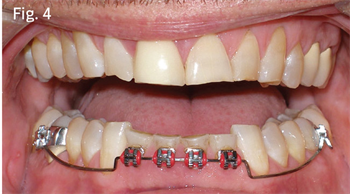 Braces vs. Aligners:  The Science of Picking the Best Appliance Dr. Daniel Grob identifies the factors critical to deciding between clear-aligner therapy and traditional metal braces.