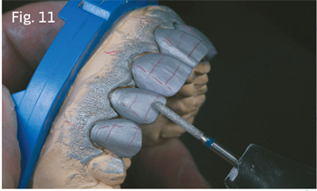 Breaking the Cookie Cutter:  Finding Our Way Back to Individuality with Shape, Form and Texture Lab technician Bill Marais argues that “one size fits all” cosmetic fixes strip patients of their visual uniqueness, and demonstrates how to create individualized restorations.