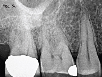 CE: Bio-Minimalism: Trends and Transitions in Endodontics In this course, Drs. Martin Trope and Kenneth Serota explore bio-minimalism, the new normal in access design and canal sculpting. 