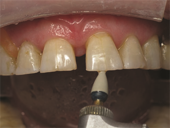  Show Your Work: Treating Incisal Edge Wear  Dr. Marvin Fier discusses situations that might lead to a patient’s eroded incisal edges and shares a case study in which he restored the physiologic contours with a universal composite.