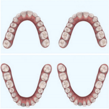 Correcting  Class I Malocclusion using Invisalign Correctors Dr. Daz Singh presents a case involving Invisalign clear correctors, followed by Maryland bridgework and composite resins.