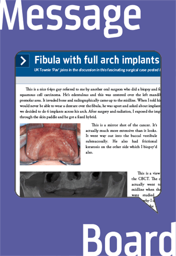 Fibula with full arch implants 
