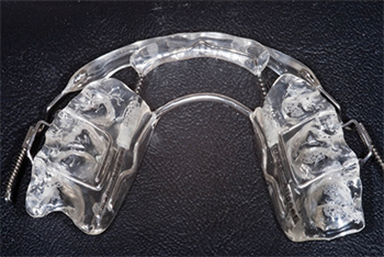 Inclined Central Incisors Using a straightforward aligner for a simple case